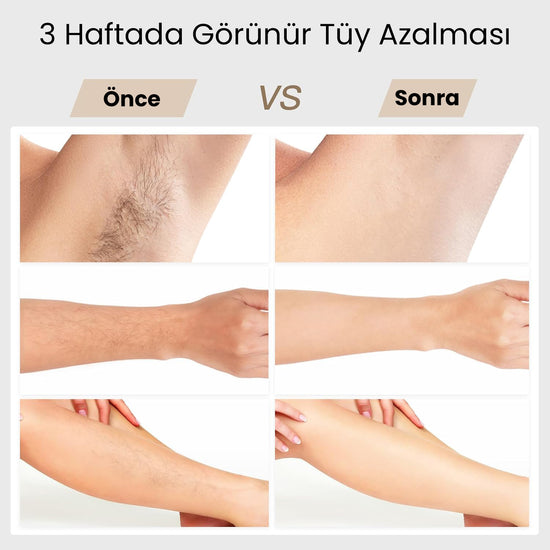 BoSidin Pro OPT Buz Lazer Epilasyon Cihazı - MedEssence