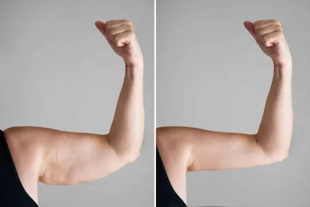 Body Sculp Kavitasyon ve RF Cihazı — İŞLEM SONRASI